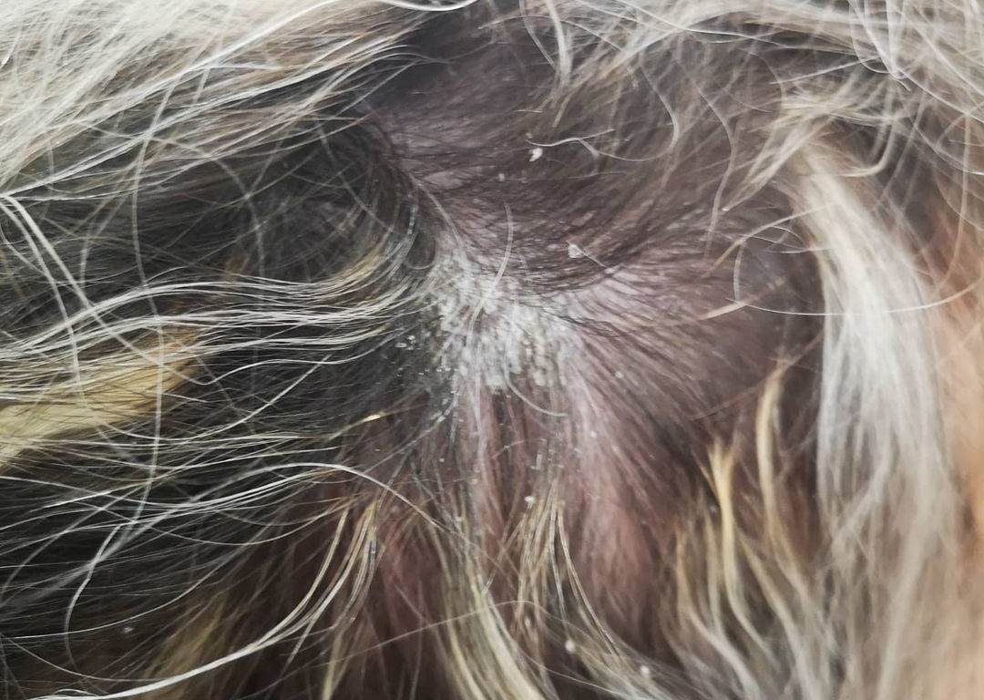 dandruff as one of the reasons for smelly scalp