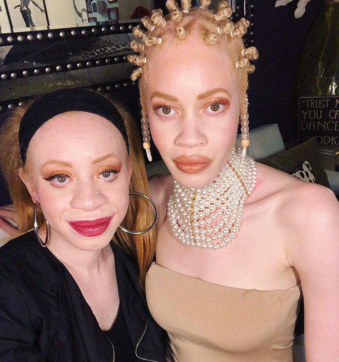 Black people with blonde hair due to albinism